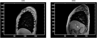 Semi-Automated Analysis of Diaphragmatic Motion with Dynamic Magnetic Resonance Imaging in Healthy Controls and Non-Ambulant Subjects with Duchenne Muscular Dystrophy